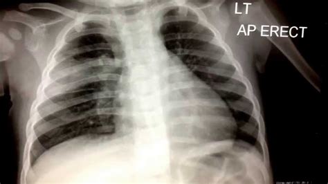 abnormal pediatric chest  ray youtube