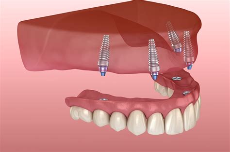 implant supported dentures lexington park dentistry