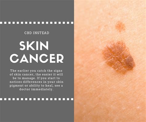 5 Warning Signs Of Skin Cancer