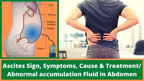 Ascites Sign Symptoms Cause And Treatment Abnormal Accumulation Fluid