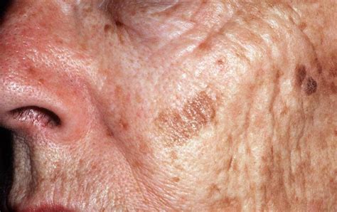 age spots     rid cream treatment