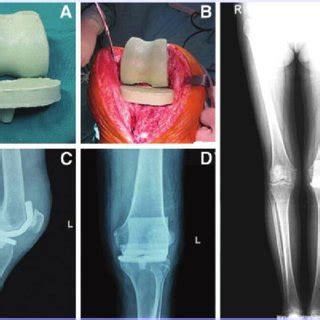 stage primary total knee arthroplasty   designed