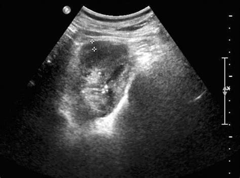 experience of ultrasonography guided percutaneous core biopsy for renal masses sciencecentral