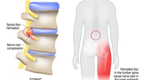 lumbar radiculopathy sciatica cahaba pain  spine care