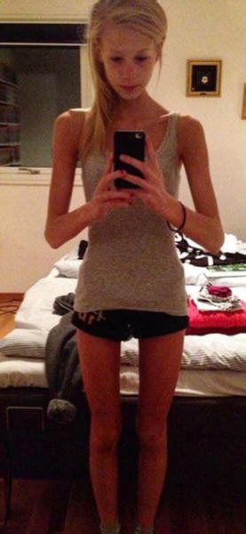 anorexic girl who was given only days to live fights her