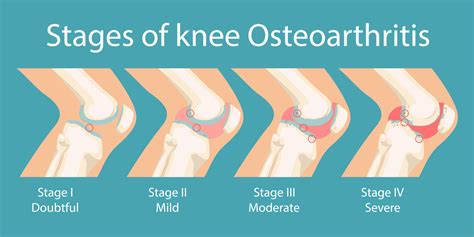 osteoarthritis stages symptoms  diagnosis  treatment
