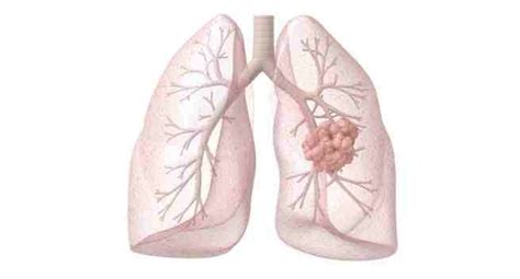 8 Common Signs And Symptoms Of Lung Cancer You Need To