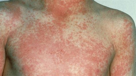 Cases Of Scarlet Fever On The Rise Heart Bristol