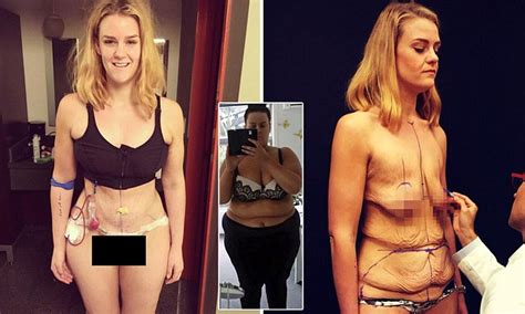 formerly obese nz woman simone anderson undergoes surgery