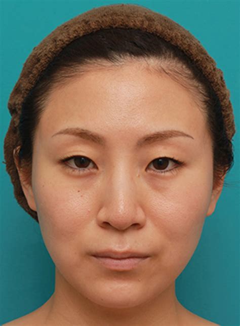 ボツリヌストキシン注射（エラ、プチ小顔術）でほっそりした小顔になった女性の症例写真の術前術後画像 ： 美容整形の高須クリニック（銀座高須