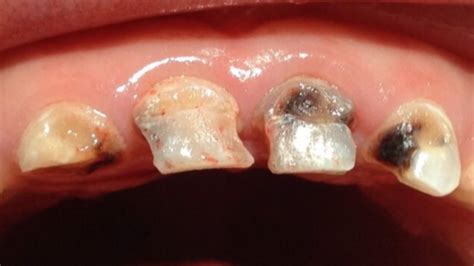 mijden tandarts  desastreus zijn voor kind vaak zwarte tanden rtl nieuws