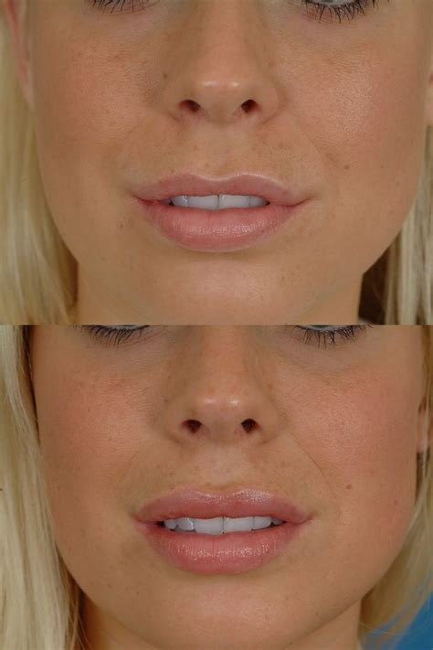 lip augmentation before and after photos dr bassichis