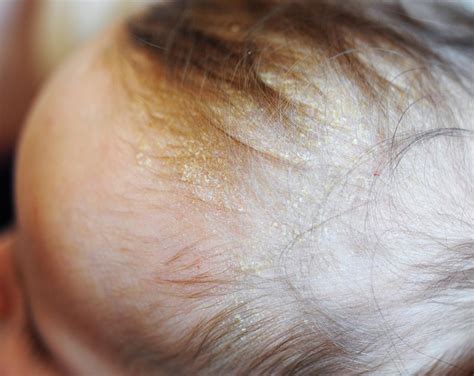 scalp treatment  dandruff cheapest  save  jlcatjgobmx