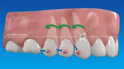 traditional attachments  aligner optimization  ortho cosmos