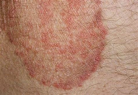 skin rash identification