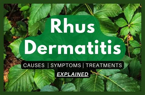 rhus dermatitis  symptoms  treatments