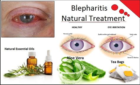 rid  blepharitis  natural remedies herbs solutions  nature