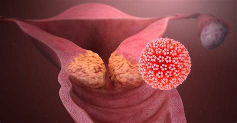 Hpv Vaccine May Reduce Risk Of Cervical Cancer Following Surgery To
