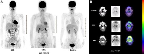 Metabolic Activity Of The Spleen And Bone Marrow In