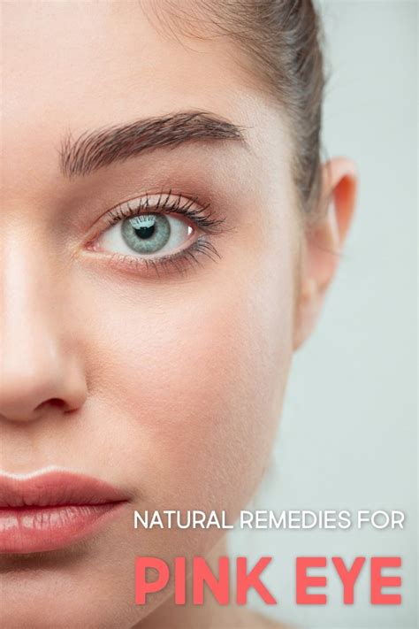 natural remedies  pink eye  relieve  heal