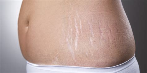 myths  stretch marks  stop believing huffpost