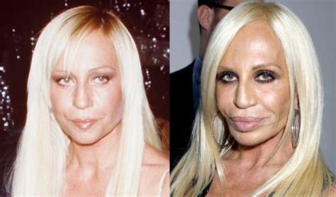 Donatella Versace Before And After Plastic Surgery 01 Celebrity