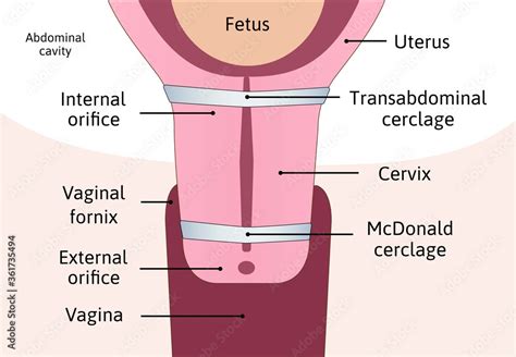 Transabdominal Cerclage Tightening Of Cervix Opening During Pregnancy