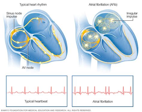 Atrial Fibrillation Beacon Health System