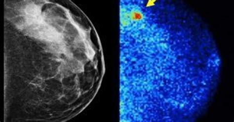 3 d mammograms and molecular breast imaging personalized approaches