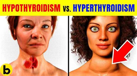 hypothyroidism vs hyperthyroidism what s the difference