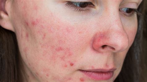 acne takes a toll on women s mental health quality of life medpage today