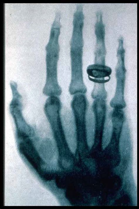 image roentgen x ray von kollikers hand psychology wiki fandom powered by wikia