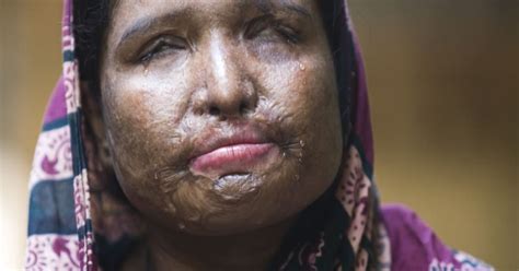 acid attack victims  equality   stop violence  campaigner monira rahman