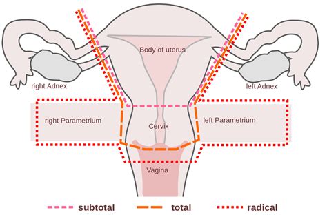 Hysterectomy Procedure Indications Complications Teachmeobgyn