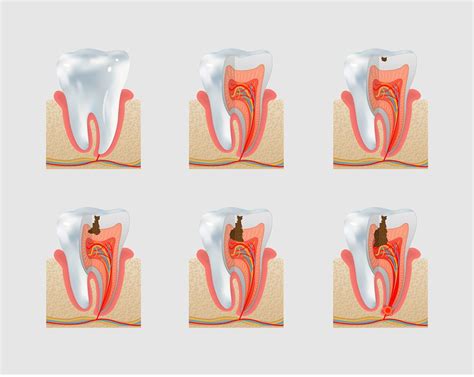 common types  cavities     treated gentle