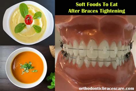 Soft Foods To Eat After Braces Tightening [with List] Orthodontic