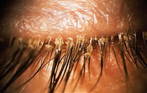 demodex infestation   eyelashes coral springs eye doctor