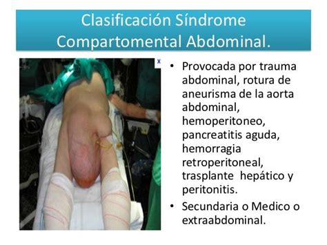 Hipertension Abdominal Y Sindrome Compartimental