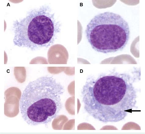 hairy cell and other b cell leukemias other freesic eu