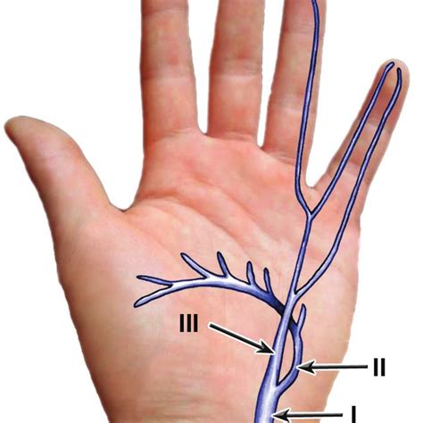 Classification Of Ulnar Nerve S Lesions Within Guyon S