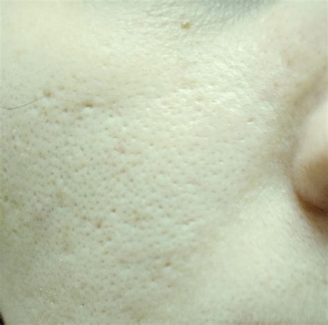 skin concerns    holes   skin     big pores   started