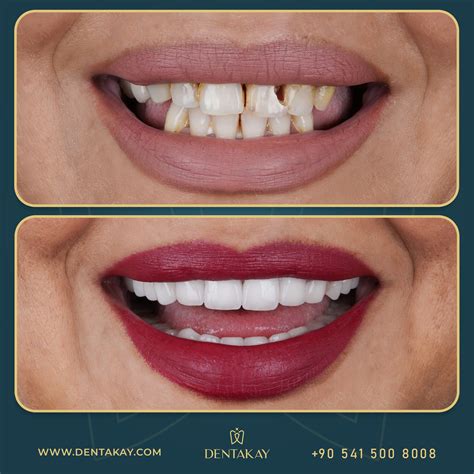 zirconia crowns    results   cosmetic