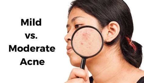 mild  moderate acne     difference vujevich dermatology