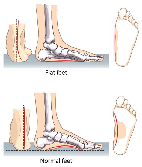flat feet       suffer