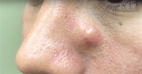 Watch Dr Pimple Popper Extract A Stubborn Growth From
