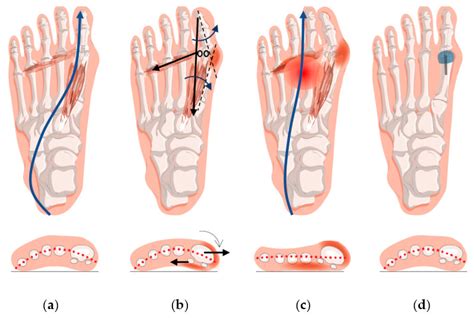 jcm  full text forefoot function  hallux valgus surgery