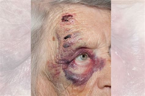 95 Year Old Woman Has Pelvis Broken During Savage Attack