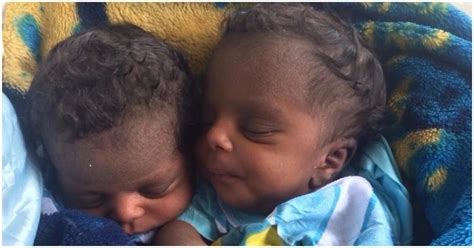 joy and relief as conjoined twins are successfully