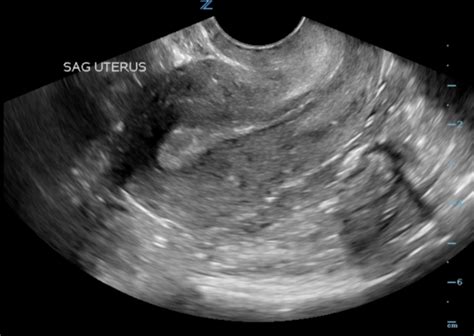 Sagittal View Of The Uterus On Trans Vaginal Ultrasound Open I Hot