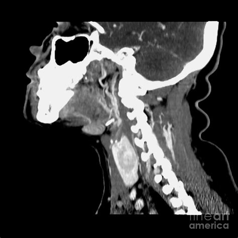 ct  neck showing thyroid nodule photograph  medical body scans